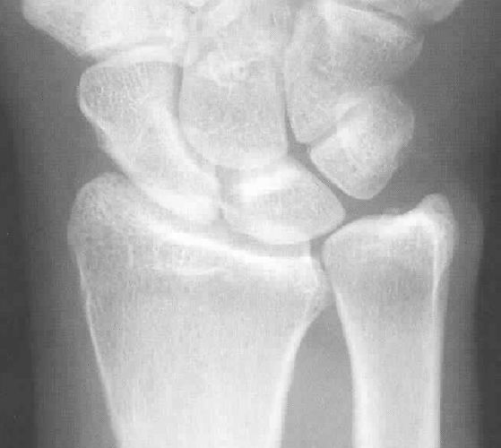 Ulnar variance orthopaedics plus